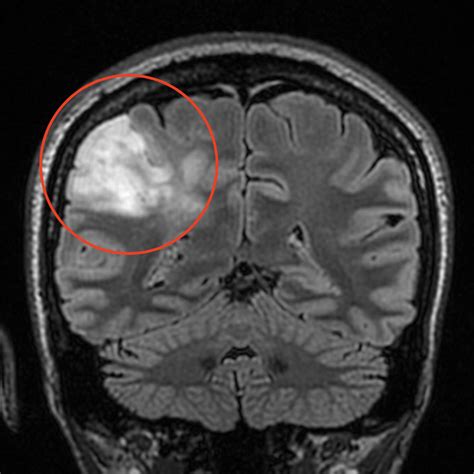 Aggressive Surgery Increases Survival with Low-Grade Brain Tumors | UC ...