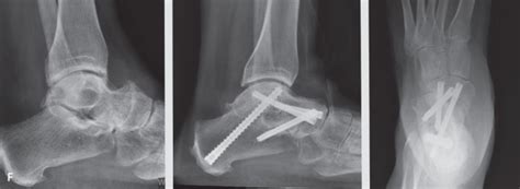 Triple Arthrodesis | Musculoskeletal Key