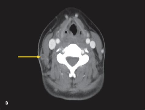 External Jugular Vein Thrombosis in an Adolescent With Lemierre ...