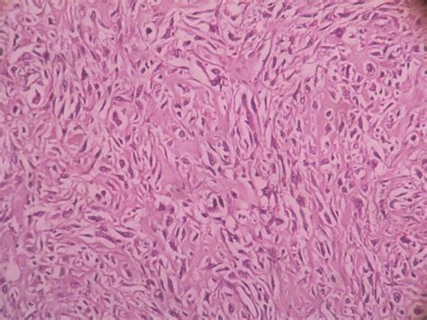 CHONDROSARCOMA – Histopathology.guru