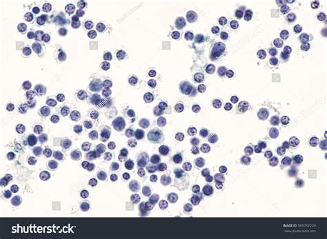 Benign Pleural Fluid Cytology Chronic Inflammatory Foto de stock ...