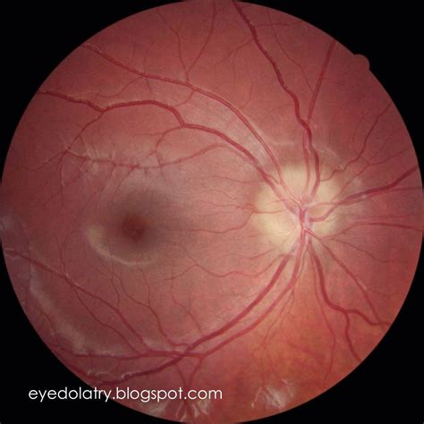 Differentiating True Optic Nerve Edema - Eyedolatry