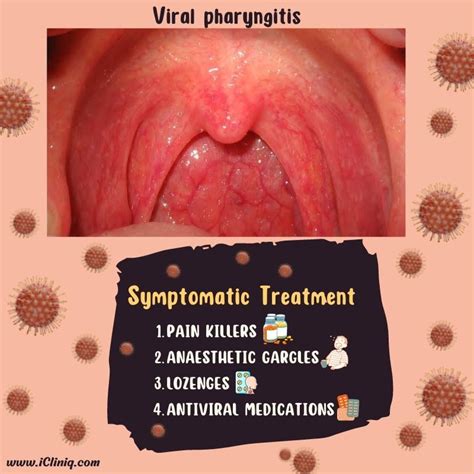 Pharyngitis Symptoms And Treatment - TheDentech.com