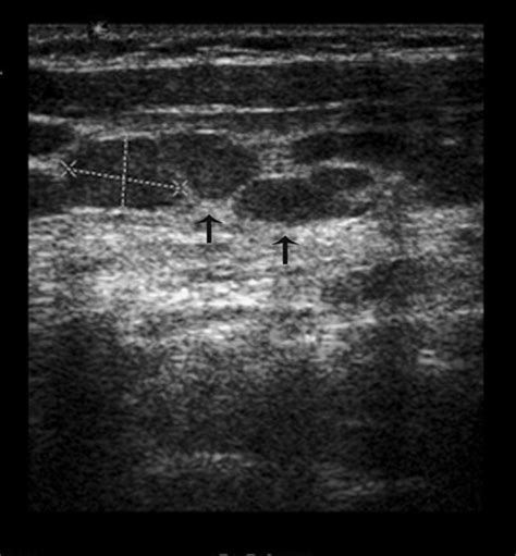 Riedel Thyroiditis Associated With Massive Neck Fibrosis - Ozbayrak ...