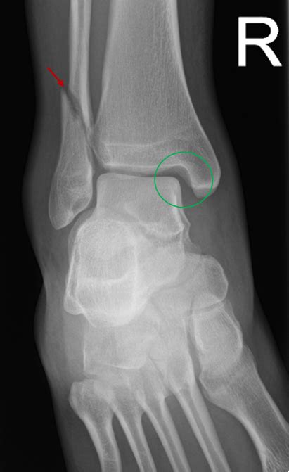 Ankle X-ray Interpretation | Ankle Fracture | Geeky Medics