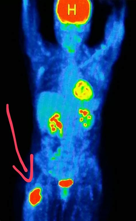 PET scan shows a malignant tumor (cancer) in the hip (femur). # ...