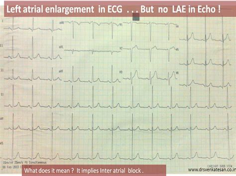 lae vs inter atrial block | Dr.S.Venkatesan MD