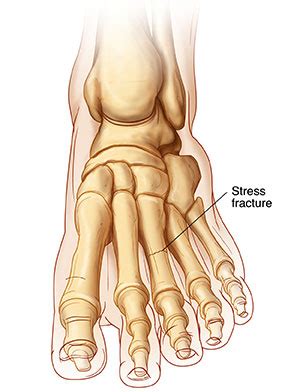 Metatarsal Bone Stress Fracture