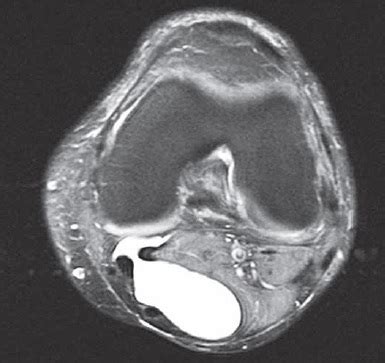 Meniscal Cysts - Knee & Sports - Orthobullets