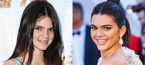 Orthodontics Australia | 6 Celebrities With Braces Before and After ...