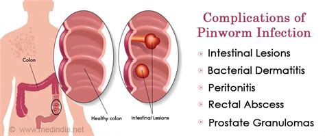 Pinworm | Thread worm Infection - Causes, Symptoms, Diagnosis ...