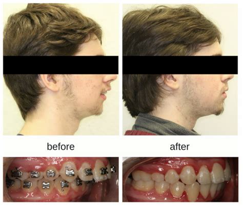 Teen Invisalign and Braces - Before and After | Hometown Orthodontics