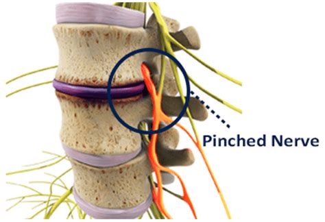 Pinched Nerve In Neck Exercises - All You Need Infos