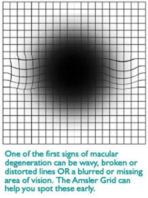 Macular Degeneration Symptoms