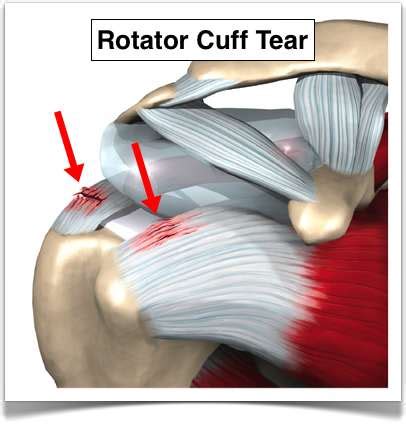 Rotator Cuff Tear On Mri