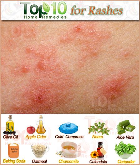 Home Remedies for Rashes | Top 10 Home Remedies