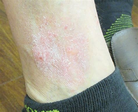 An Intensely Itchy Unilateral Rash on a Man’s Lower Leg: What’s the ...