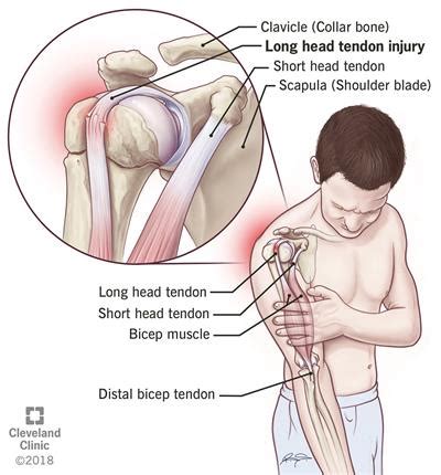 Biceps Tendon Injuries: Causes, Symptoms & Treatments