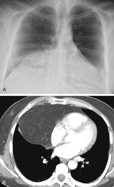 Anterior Mediastinal Mass | Radiology Key