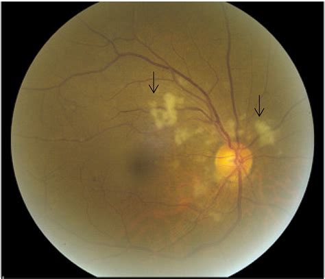 Purtscher's retinopathy: a case report and review - The American ...