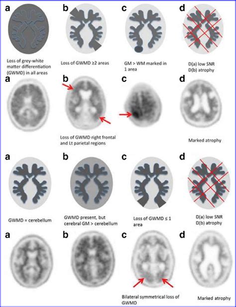 Positive amyloid PET imaging-type A & non-type A (B-D). 14 (B) Negative ...