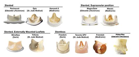 Bioprosthetic surgical aortic valve (SAV) construction