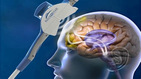 How TMS Therapy Works - Tranquility TMS Center