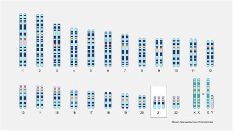 Down Syndrome (Trisomy 21)