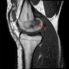 Bone marrow edema