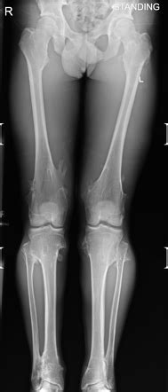 Hereditary multiple exostoses (HME) | Radiology Case | Radiopaedia.org