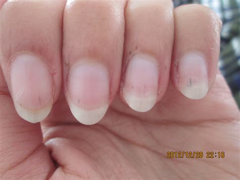 Ive realized that I have splinter hemorrhages on my nails