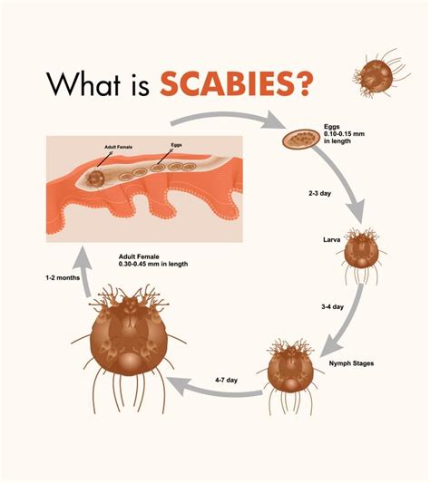 Scabies In Kids: Causes, Symptoms, Diagnosis And Treatment