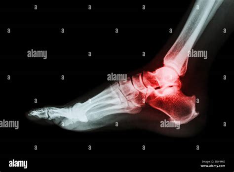 Arthritis at ankle joint (Gout , Rheumatoid arthritis Stock Photo ...