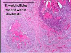 Thyroid pathology Flashcards | Quizlet