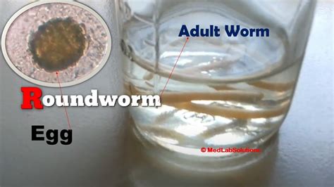 Roundworms In Stool