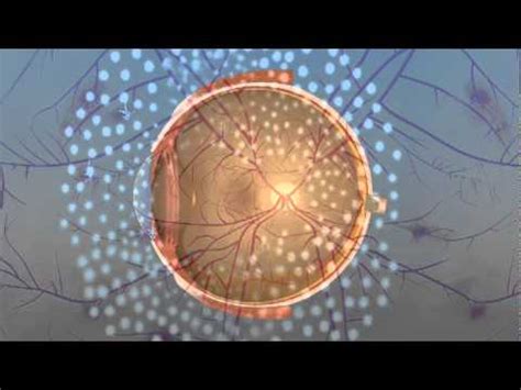 Vitrectomy Surgery for Diabetic Retinopathy - YouTube