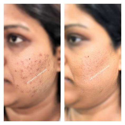 Hyperpigmentation Treatment in Mumbai - Dark Patches Removal