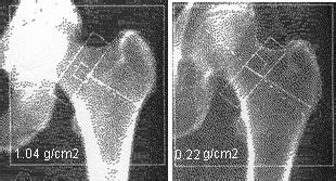 Bone density chart by age - dashmokasin