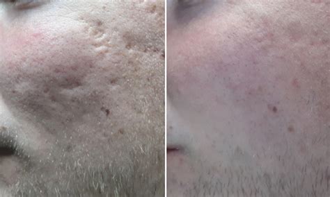 Severe Acne Scars Before And After