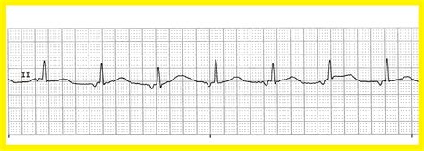 Float Nurse: Various Accelerated Junctional Rhythms