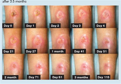 Figure 3 from Healing of an arterial leg ulcer by compression bandaging ...