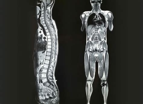 Whole-body MRI for Identifying Metastatic Disease in Colorectal Cancer ...