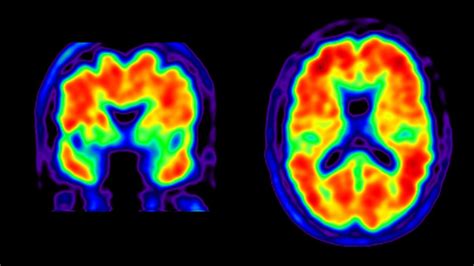 Alzheimer’s Diagnosis, Management Improved by Brain Scans | UC San ...