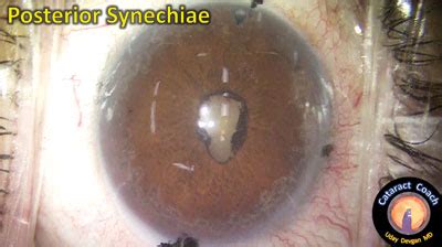 Synechiae can be managed during cataract surgery