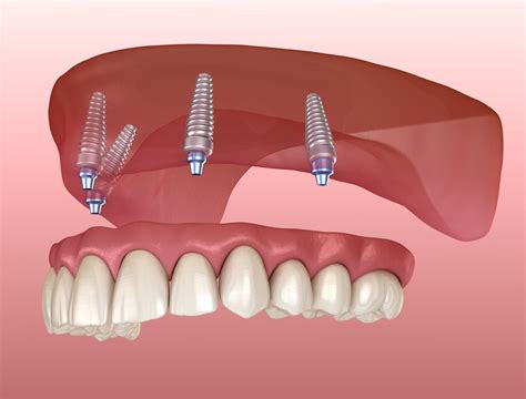 Dental Implants & Implant Fixed Dentures - Tulsa Precision Dental