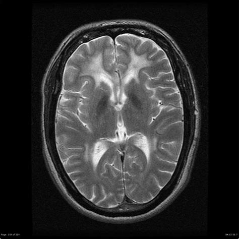 Metachromic Leukodystrophy - Neurology - Medbullets Step 2/3