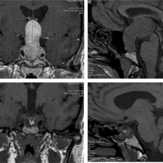 Coronal and sagittal planes from pituitary MRI of a giant prolactinoma ...