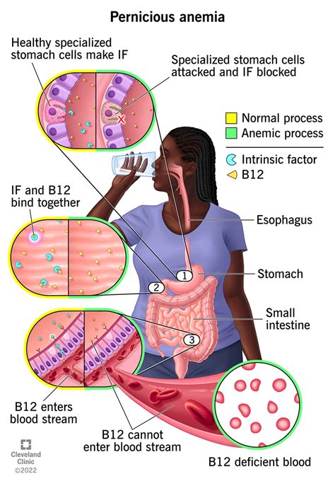 Vitamin B12 Deficiency Symptoms Tongue