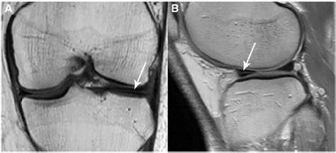 Horizontal Meniscal Tear Mri