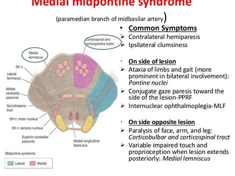 Medial Pontine Syndrome